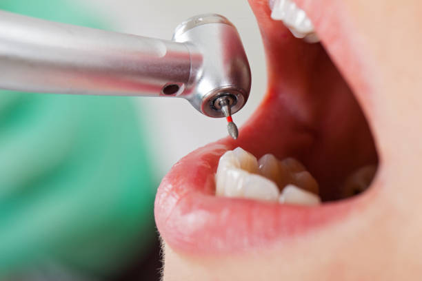 Best Dentist for Tooth Abscess  in Holcom, KS